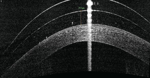 Figure 4. An optical coherence tomography image showing too much clearance for a mini-scleral lens.