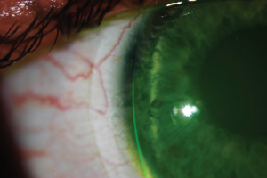 Figure 4. depicts an appropriate diameter on a normal eye, usually around 14.9 millimeters. Photo Courtesy to Blanchard Contact Lens, Inc.