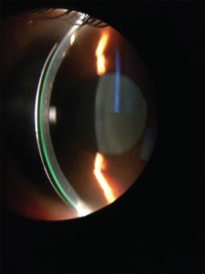 Figure 3. shows an optic section being used to evaluate and measure contact tear film clearance on a smaller mini-scleral lens. The thickness of the contact lens is 280 microns and in comparison, the tear film is approximately 150 microns.